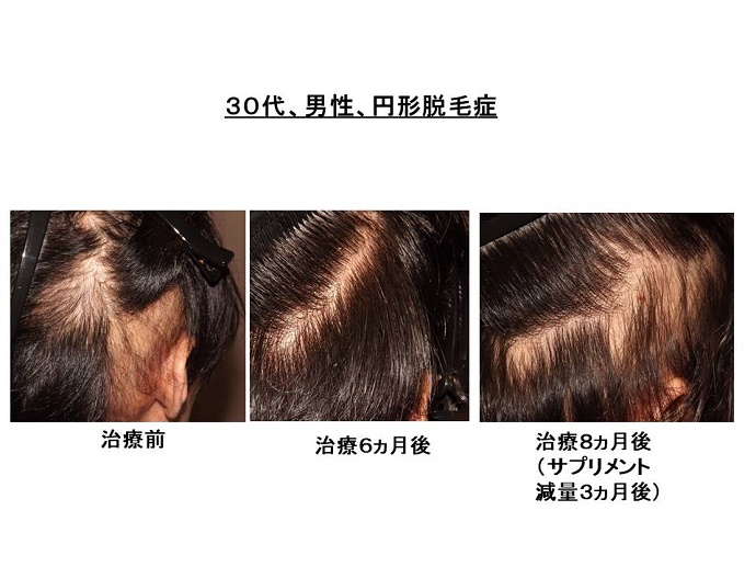 円形脱毛症　病院""